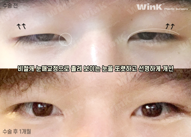 남자 속쌍커풀 수술에 대해 알아보자 관련 이미지 4