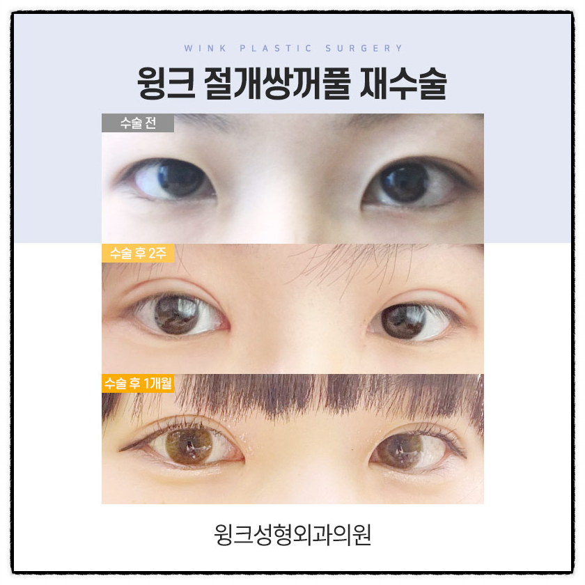 쌍꺼풀절개재수술 절개쌍수재수술후기로 흉터부터 회복까지 알아보자! 관련 이미지 5