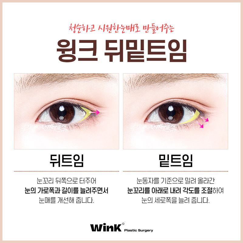 윙크성형외과 뒤밑트임으로 청순한 이미지 만들기! 관련 이미지 3