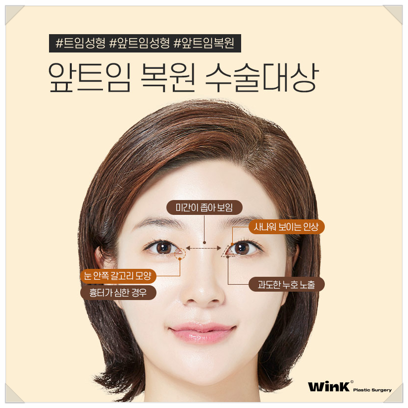 앞트임복원회복기간 앞트임복원후기 윙크성형외과 신사앞트임복원후기 앞트임부작용 관련 이미지 5