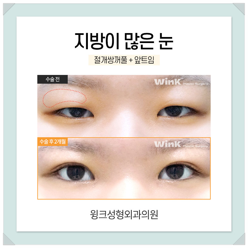 지방이많은눈 눈두덩이지방제거 절개쌍수비용을 알아보겠습니다. 관련 이미지 4