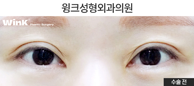 Turning a Thick Outer-Line Double Eyelid into a Natural Inline Through Double-Fold Revision image 2