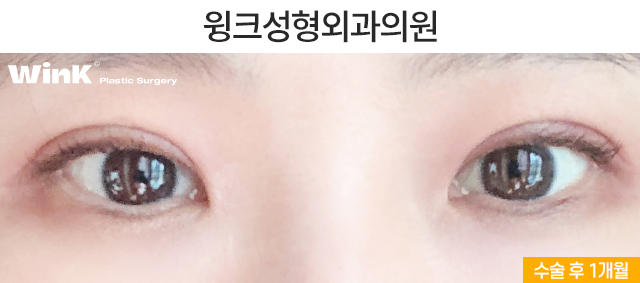 Turning a Thick Outer-Line Double Eyelid into a Natural Inline Through Double-Fold Revision image 6