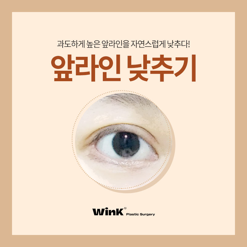 앞쪽이 두꺼운 아웃라인 쌍꺼풀, 해결 방법은? 관련 이미지 1