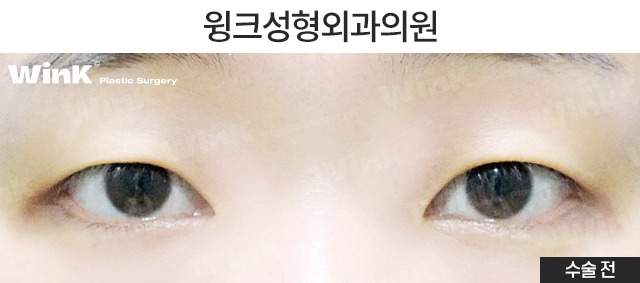 절개 눈매교정 쌍꺼풀 수술에 대해 알아볼까요? 관련 이미지 2