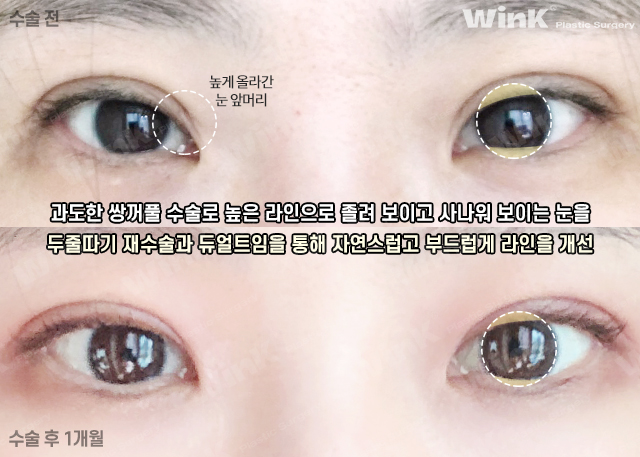 Turning a Thick Outer-Line Double Eyelid into a Natural Inline Through Double-Fold Revision image 7