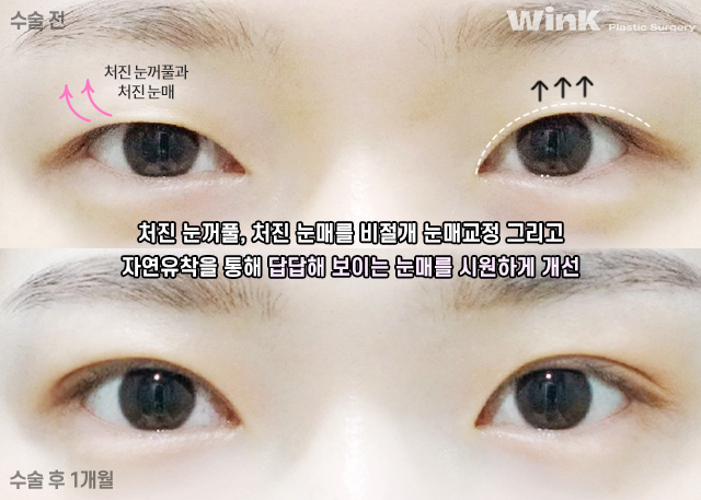 Let’s Take a Look at Double Eyelid Surgery for Droopy Eyes. image 7