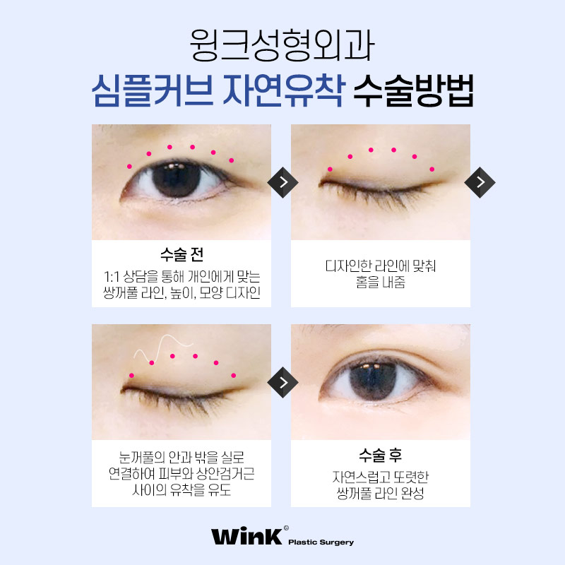 윙크성형외과 심플커브 자연유착 자연유착쌍꺼풀후기 자연스러운쌍수 쌍수자연유착 관련 이미지 3