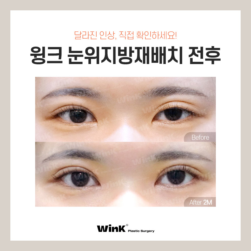 Lift Tired-Looking Eyelids with Upper Eyelid Fat Repositioning at Wink Plastic Surgery! image 5