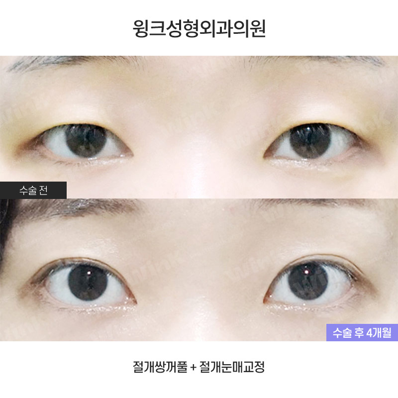 절개 눈매교정 쌍꺼풀 수술에 대해 알아볼까요? 관련 이미지 1