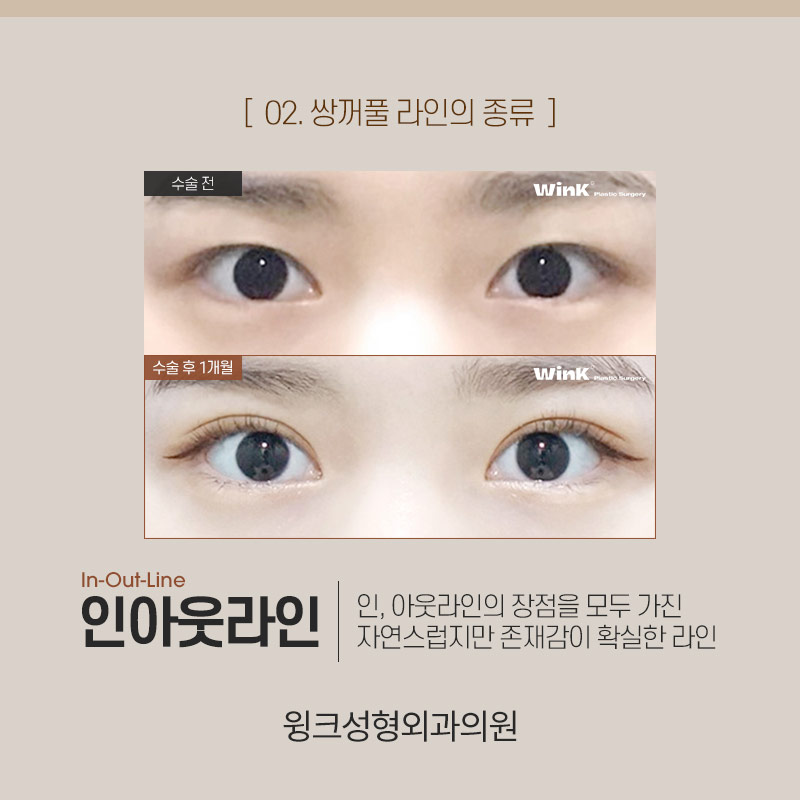 인아웃연예인은 누가 있을까? 윙크성형외과와 알아보는 쌍꺼풀 라인 종류! 관련 이미지 5