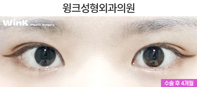 Let’s Learn About Before and After Natural Adhesion Double Eyelid Surgery image 3