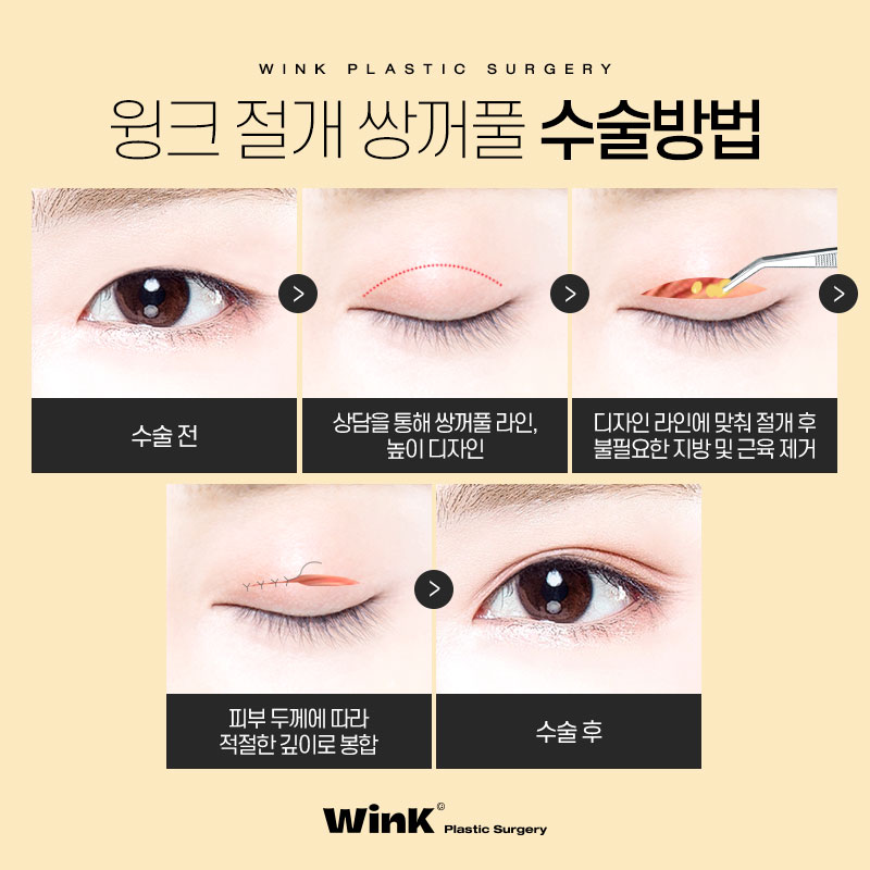 신사절개쌍꺼풀 쌍수절개후기 윙크성형외과 절개쌍꺼풀 관련 이미지 4