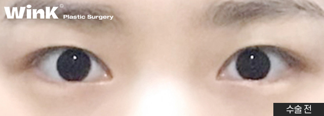 Can I Have My Eyes Surgery Done with Natural Adhesion Too? image 5