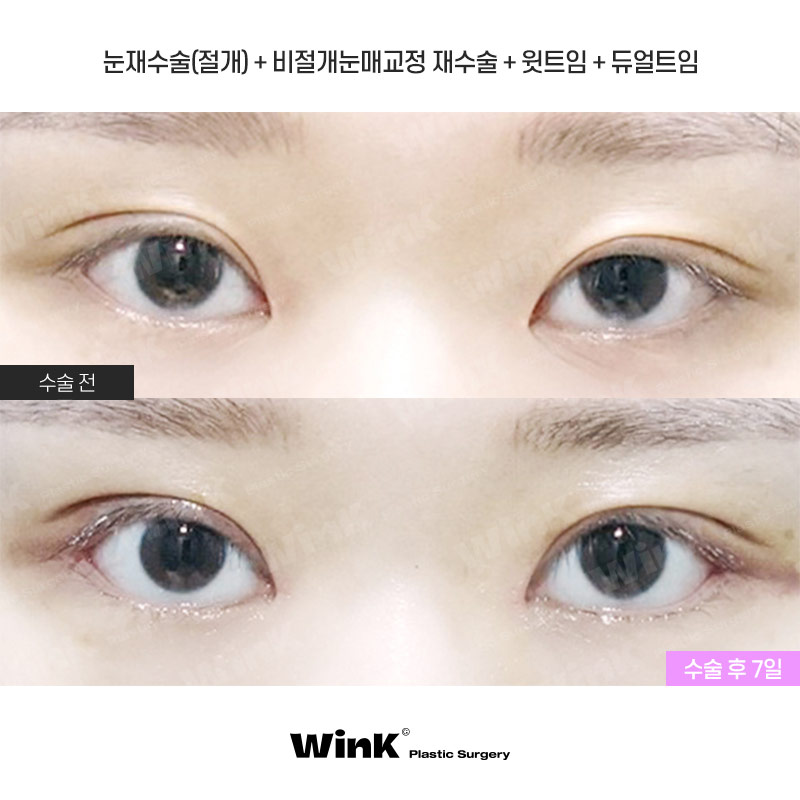 눈동자 노출량을 키워주어 또렷한 눈매로 만들어주는 윙크성형외과 눈매교정! 관련 이미지 1