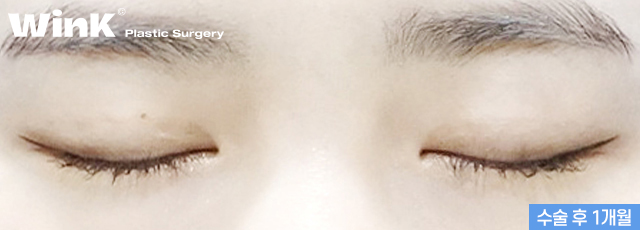 Can I Have My Eyes Surgery Done with Natural Adhesion Too? image 7