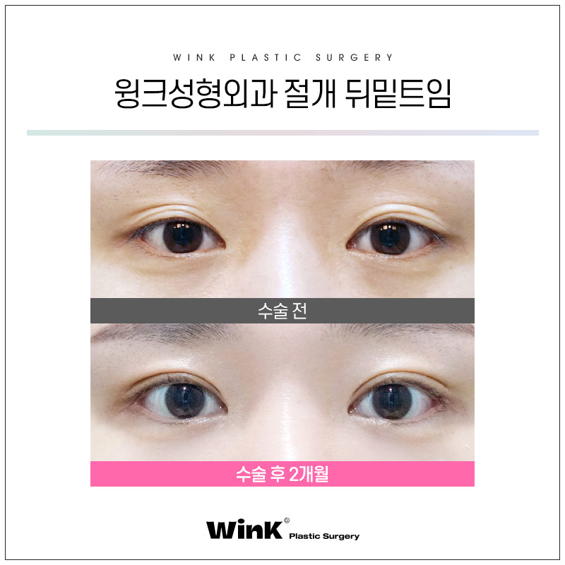 윙크성형외과에서 알려드리는 트임에 관한 모든 것! 관련 이미지 3
