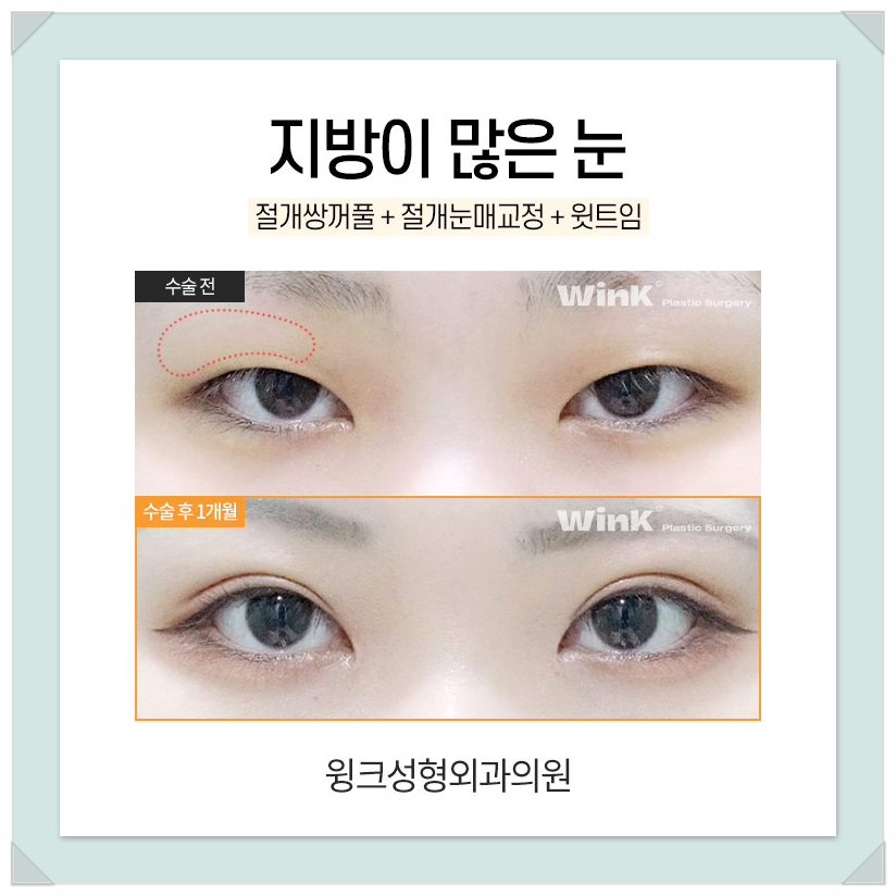 지방이많은눈 눈두덩이지방제거 절개쌍수비용을 알아보겠습니다. 관련 이미지 5