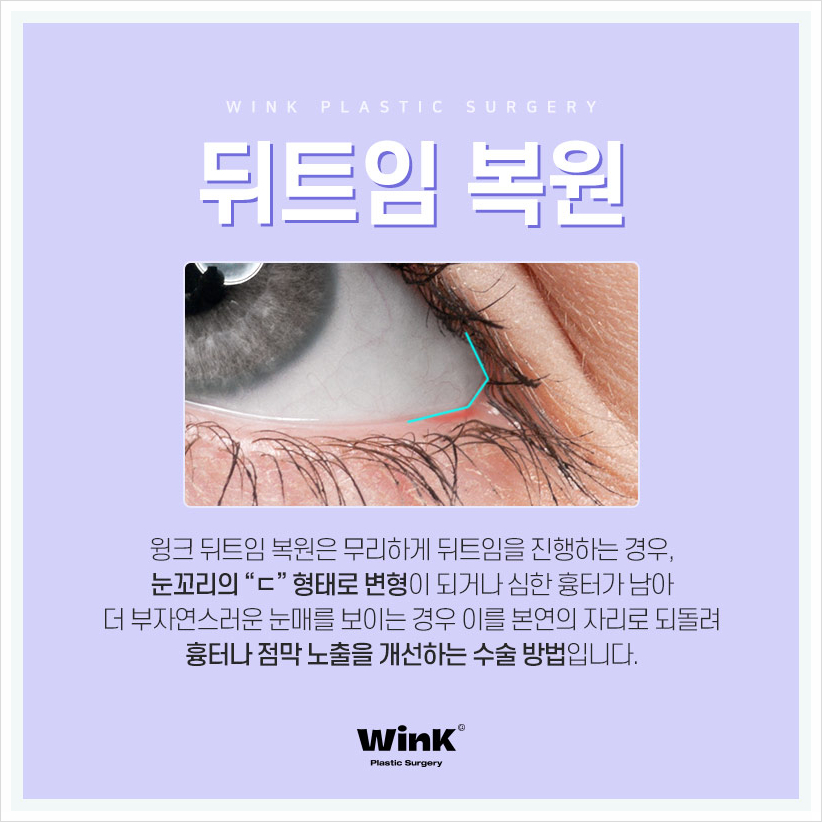 뒤트임부작용으로 뒤트임복원 신사뒤트임재수술 알아본다면 윙크성형외과 관련 이미지 2