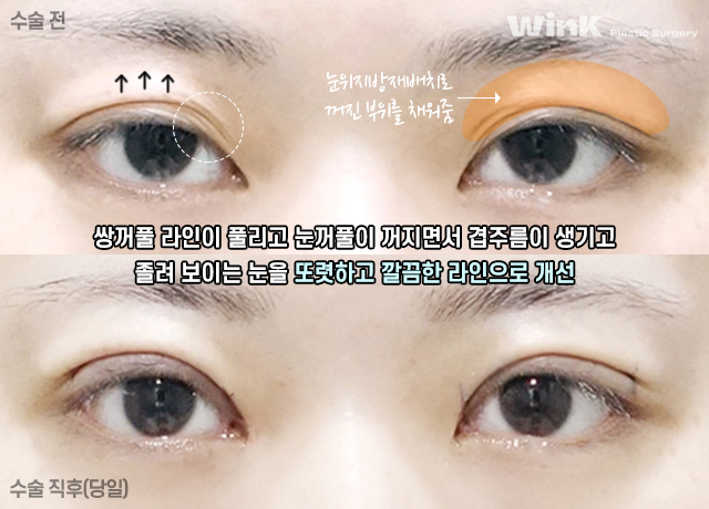 마지막 눈 성형, 눈매교정으로 또렷하게 개선해 드리는 윙크성형외과 눈재수술! 관련 이미지 7