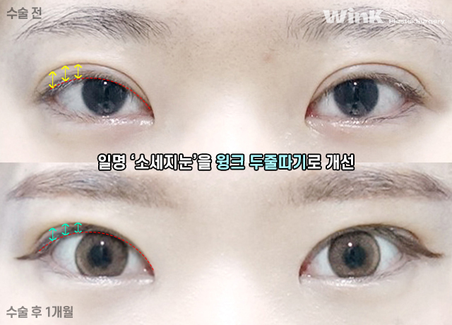소세지눈? 윙크성형외과 두줄따기가 정답! 관련 이미지 14