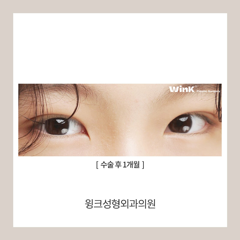 자연유착쌍수후기 자연유착전후를 알아본다면 윙크성형외과가 정답! 관련 이미지 5