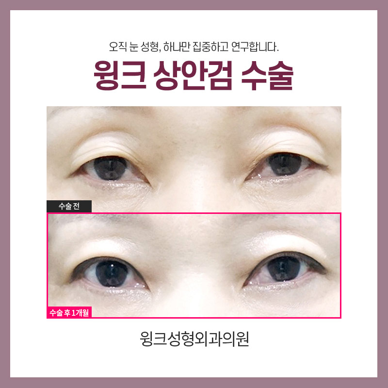 중년눈성형 상안검수술을 알아보자. 관련 이미지 5
