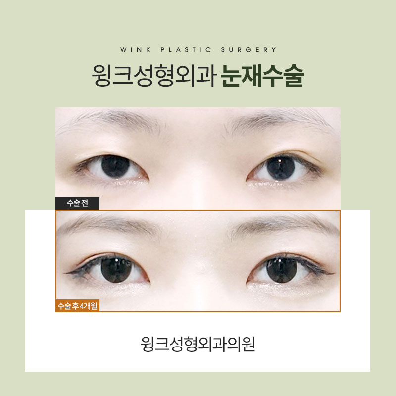 Let’s Take a Look at What to Consider When Undergoing Revision Double Eyelid Surgery. image 4