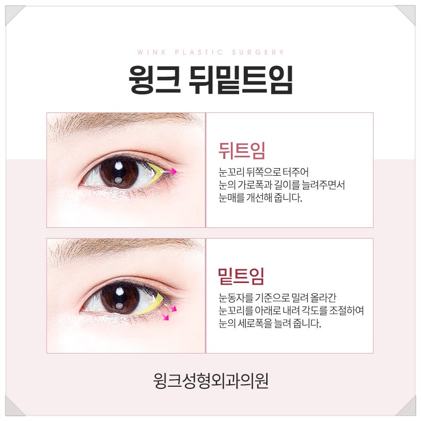 If You’re Looking Into Reviews of Dual Canthoplasty That Softens a Fierce Look image 3