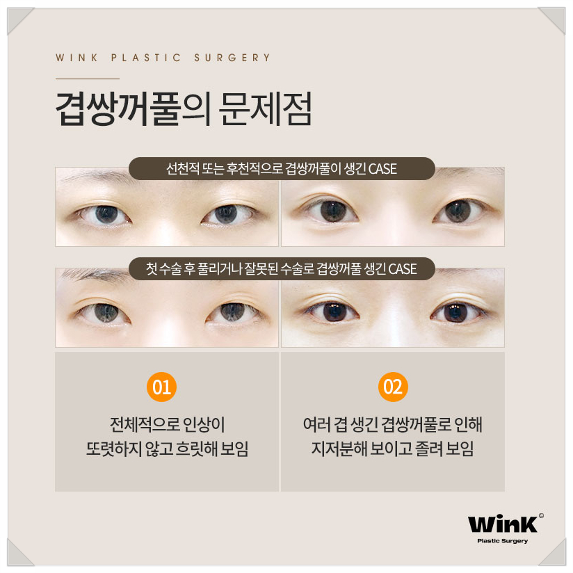 겹주름쌍꺼풀 쌍커풀여러겹 윙크성형외과  겹쌍 쌍커풀주름 관련 이미지 3