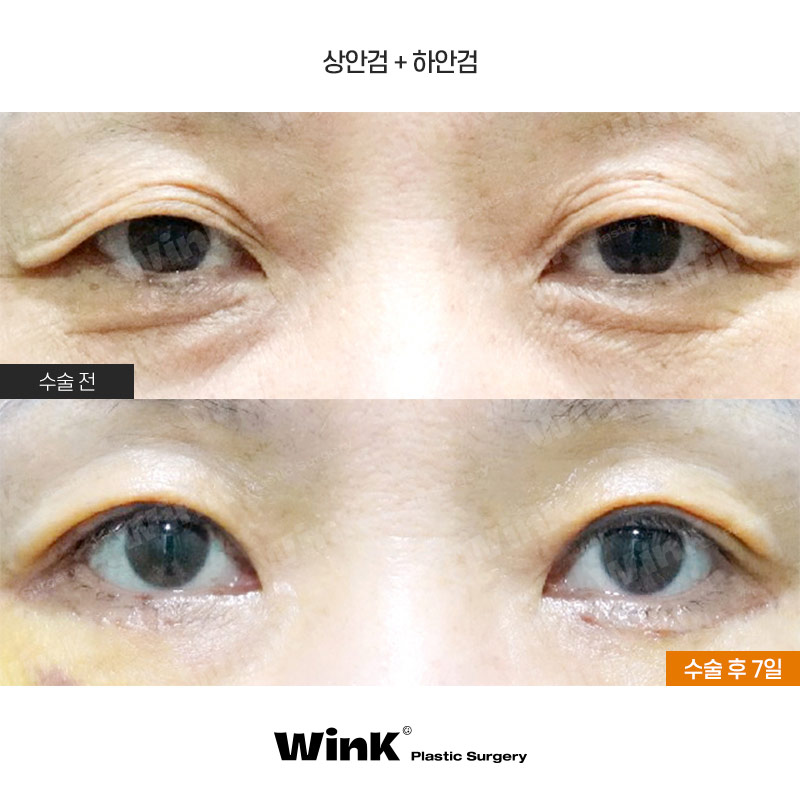 Sagging Eyelids That Have Lost Elasticity: A Youthful Eye Look with Upper Blepharoplasty at Wink Plastic Surgery image 1