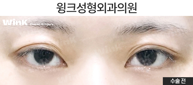 마지막 눈 성형, 눈매교정으로 또렷하게 개선해 드리는 윙크성형외과 눈재수술! 관련 이미지 5