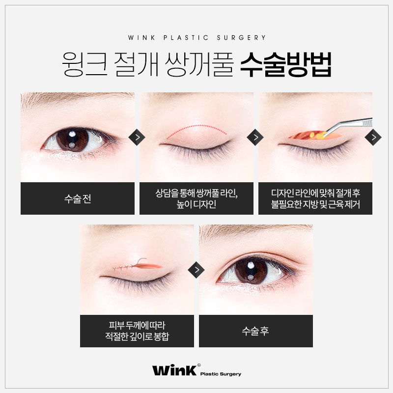 Wink Plastic Surgery Incisional Double Eyelid Surgery Offers Fast Recovery with Minimal Bruising and Swelling! image 3
