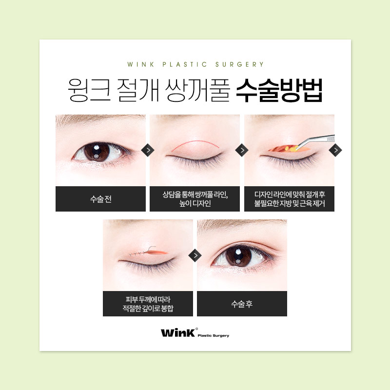 윙크성형외과는 절개쌍꺼풀 수술 후에도 빠르게 회복! 관련 이미지 4