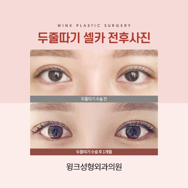 A sausage line can be improved with double-line blepharoplasty revision surgery. image 5