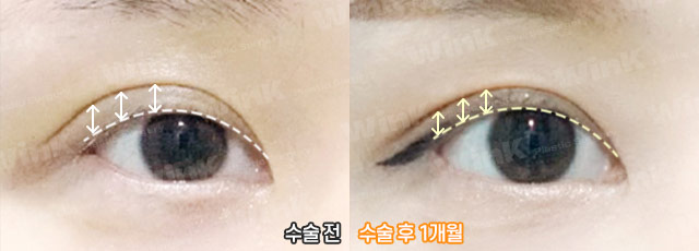 Wink’s Upper Blepharoplasty Revision Surgery, Considering Both Function and Aesthetics image 9