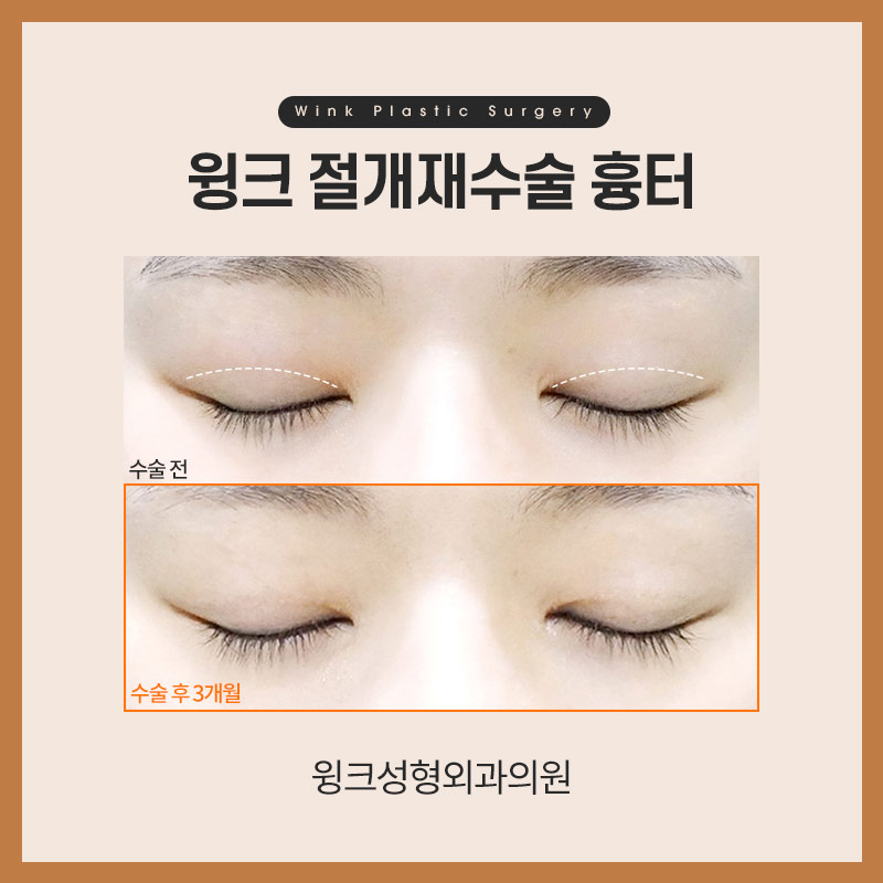 절개쌍꺼풀 절개재수술 흉터도 자연스럽고 깨끗하게! 관련 이미지 3