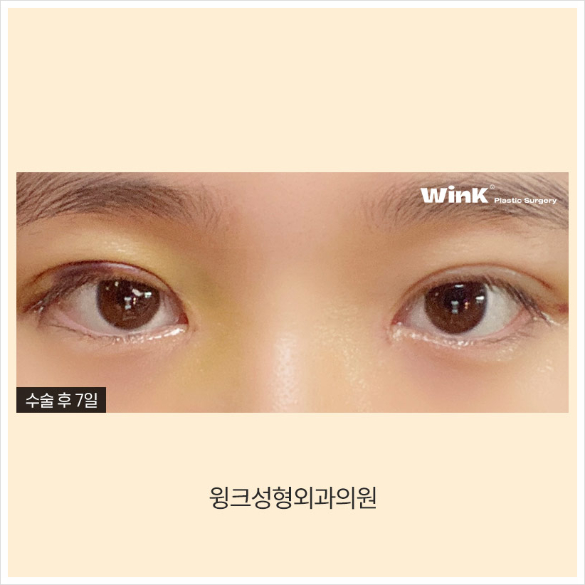 인라인쌍꺼풀 윙크성형외과 자연유착쌍꺼풀후기 자연유착법 관련 이미지 4