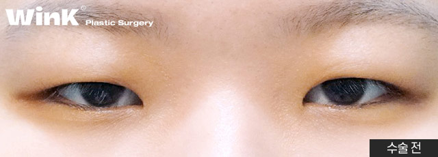 Is Fast Recovery Only Possible with Non-Incisional Surgery? At Wink Plastic Surgery, Incisional Double Eyelid Surgery Can Also Return You to Daily Life Quickly! image 2