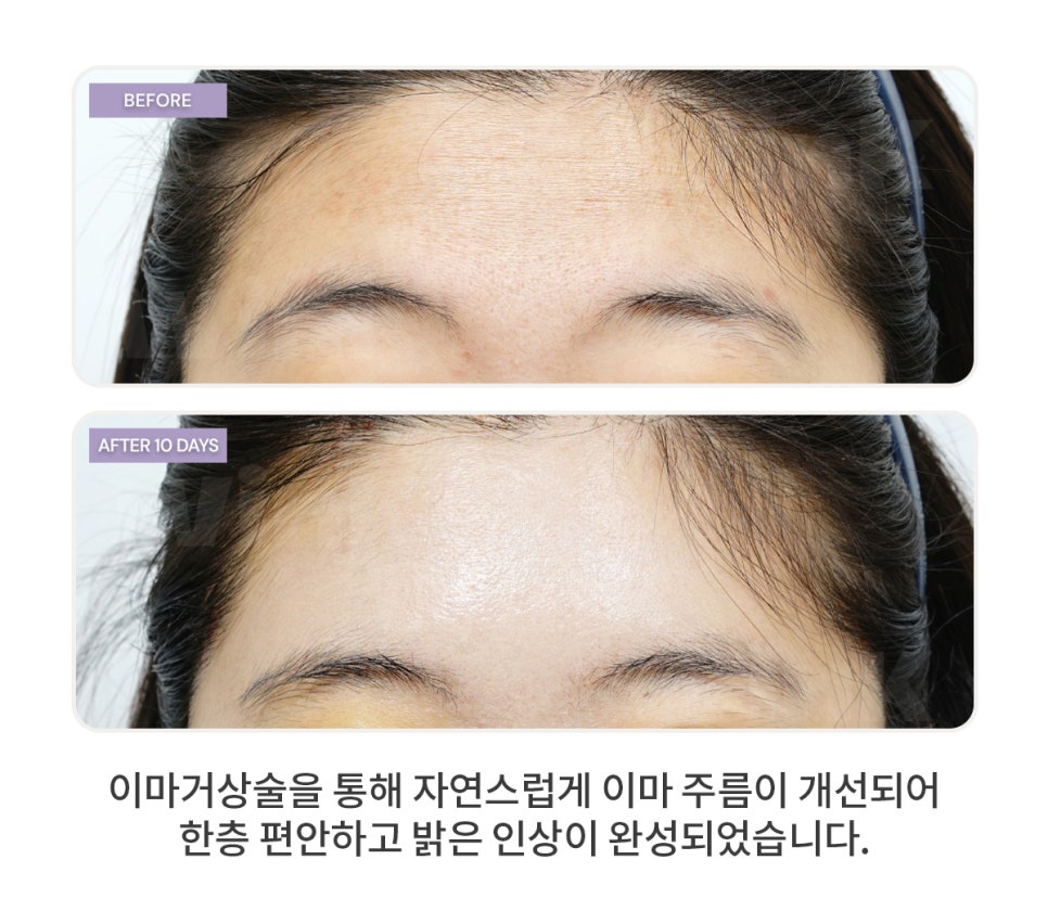 Forehead Lift (Forehead Lifting) — Why It Should Be Considered Along with Eye Surgery image 3