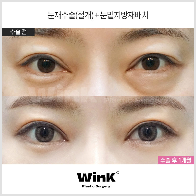 신사눈재수술후기 신사눈재수술전후 윙크성형외과 눈재수술 관련 이미지 1