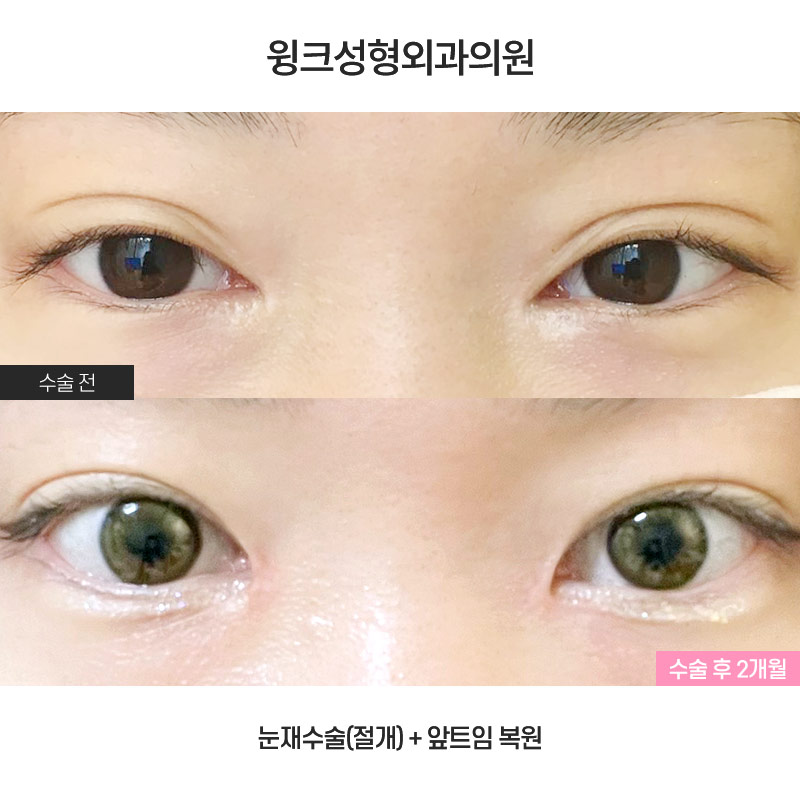 Let’s Learn About Epicanthoplasty Revision and Reconstruction image 1