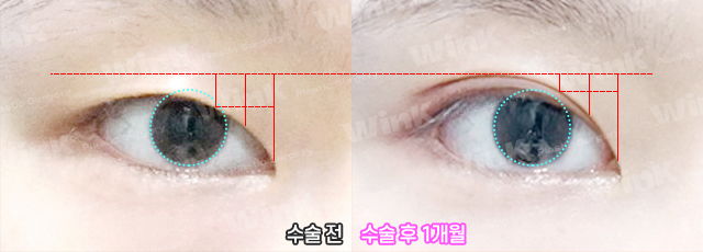 If you want to create the double eyelid line you want without being limited by your eye shape, Wink Incision Double Eyelid Surgery! image 11