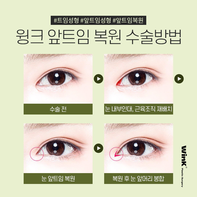 Wink Epicanthoplasty Restoration to Reclose Delicately Opened Inner Eye Corners! image 6