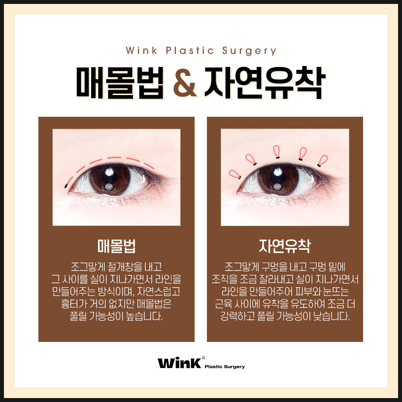 Shinsa Natural Adhesion Double Eyelid Review | Natural Adhesion Double Eyelid Surgery | Wink Plastic Surgery | Natural Adhesion Double Eyelids image 3
