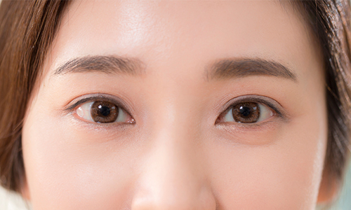 Double-Fold Re-creation, Is It the Right Revision Double-Eyelid Surgery for Me? image 2