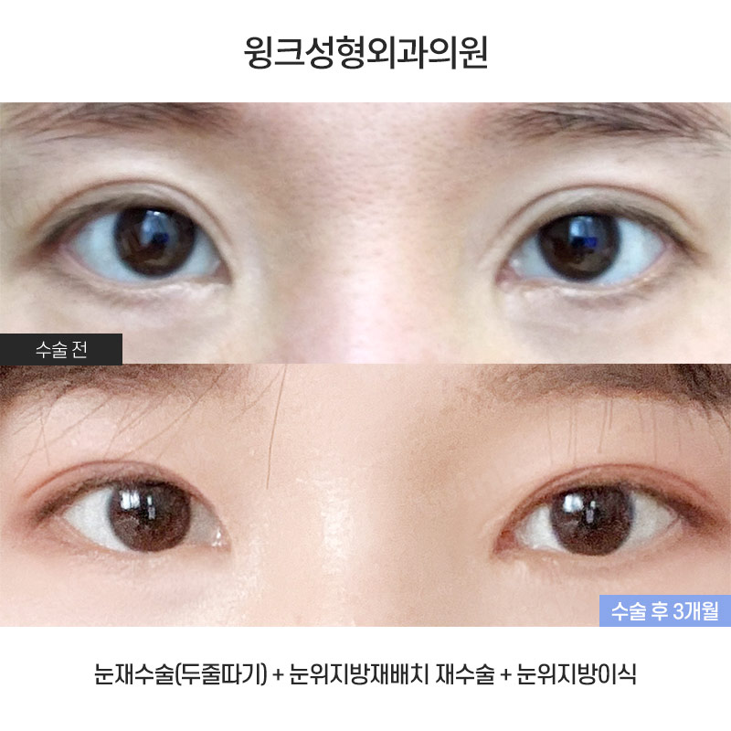 What Kind of Double Eyelids Suit Deep-Set Eyes? image 1