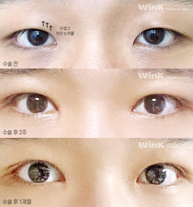 Let's Learn About Male Eye Correction and Eye Plastic Surgery image 4