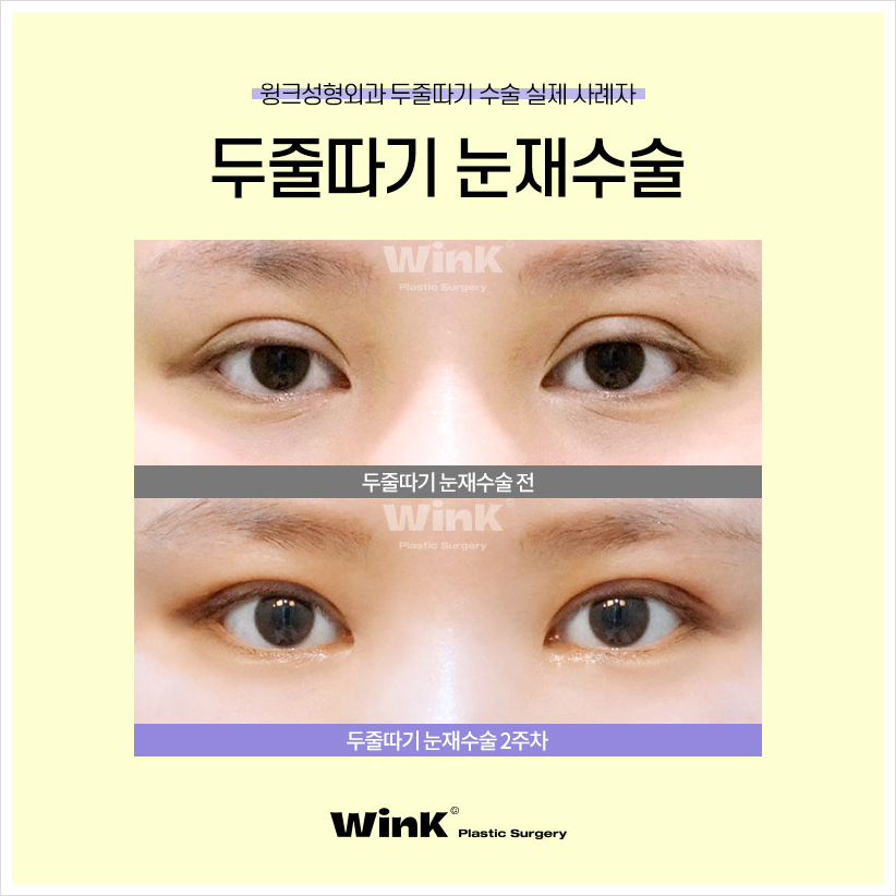 쌍꺼풀재수술 두줄따기눈재수술 윙크성형외과 소세지눈재수술 관련 이미지 6