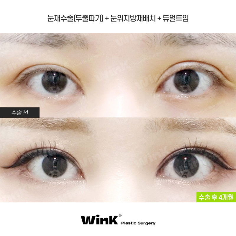 Thick Double Eyelids, “Sausage Eyes.” Let’s Improve Them Naturally with Wink’s Double-Incision Double Eyelid Revision Surgery! image 1